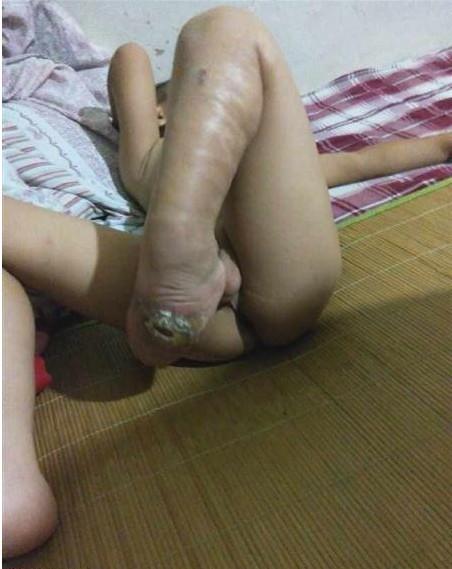 小鑫诺的先天性马蹄足内翻畸形的脚,他走路都是用脚背进行走的,导致脚背发炎恶化