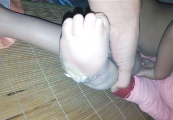 小鑫诺的脚已经完全变形了