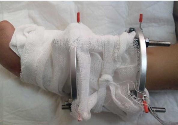 小鑫诺的腿装上了矫正的装置