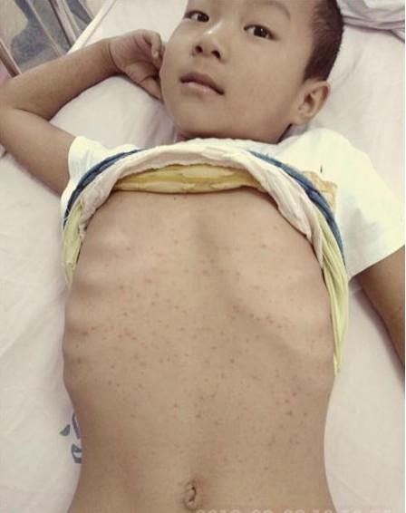 第一疗程的化疗副作用引起的败血症和紫癜 笑的还是怎么开心,笑对白血病,坚强的孩子,爸妈怎么忍心放弃你