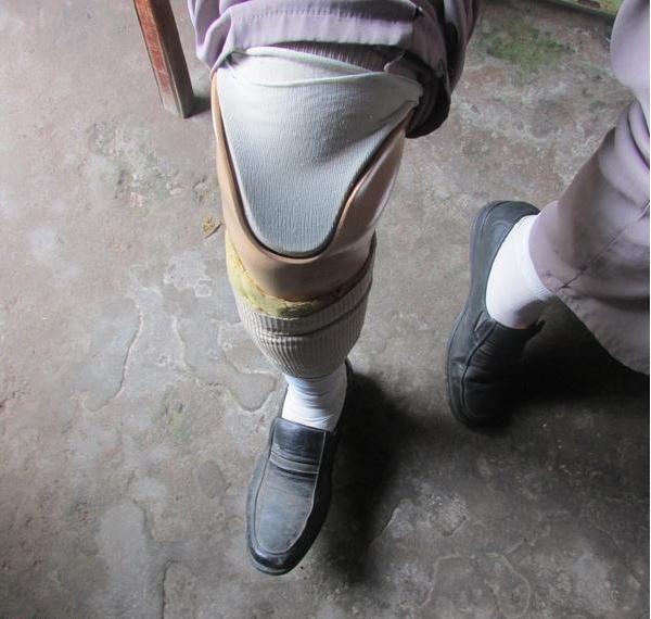 吴孝星因车祸导致残疾腿,现在不能走路,用器材固定着的