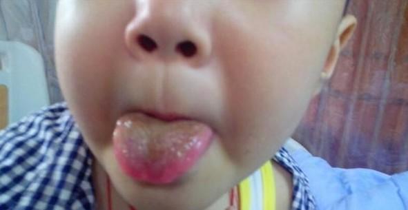 口腔发炎及身体多部位发炎,导致其其进仓化疗时间一再推迟