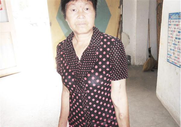 张玲凤患有尿毒症,每个月都在医院做治疗,手臂上做治疗非常明显。