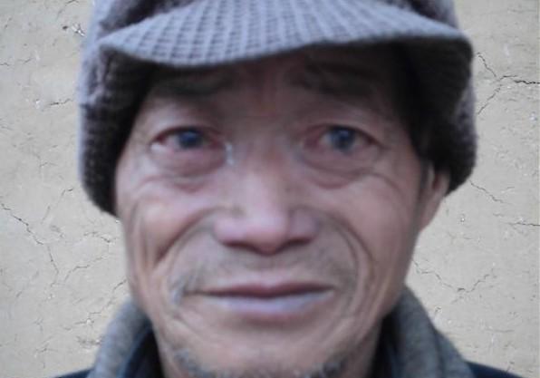 贫困了一生的孤寡老人冯青松,因患眼疾没有及时医治,现在眼睛看不清楚