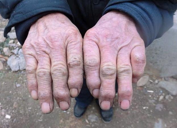 老人的双手因为常见劳作,严重变形