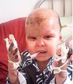 毛鑫宇几个手指已经坏死,需要做整形手术,才可以拿起重物。