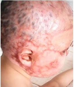 毛鑫宇头发已经被烧光了,以后再也长不出头发了