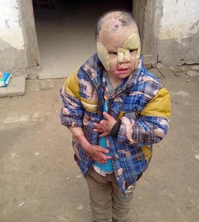 毛鑫宇手部和头部严重烧伤