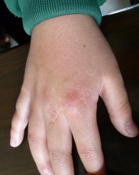 张志兵残疾的人,是被大石头压伤的