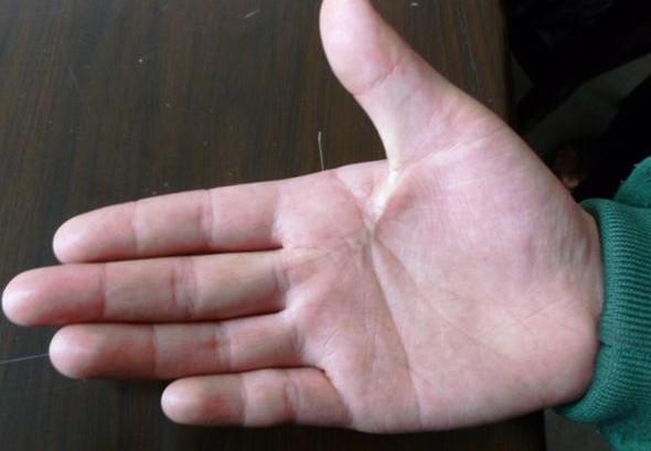 张志兵受伤的手做了手术,终生致成了疤痕,现手指活动受限,不能拿重东西。