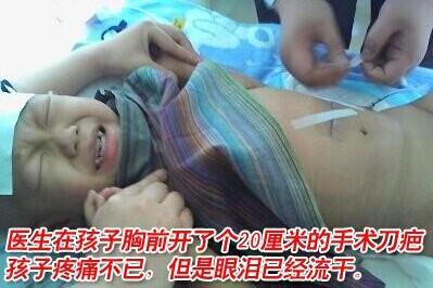 医生在孩子胸前开了个20厘米的手术刀疤,孩子疼痛不已,但是眼泪已经流干。