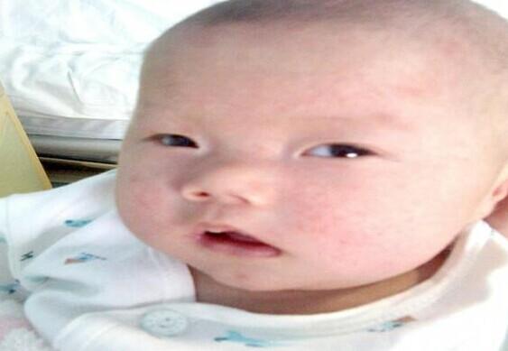 2013年8月8日:因为长期发烧和用药,满脸都还是红疹子,屁股也是掉了一层皮。这是从她住院至今两个月以来第一次看到,都长那么大了。