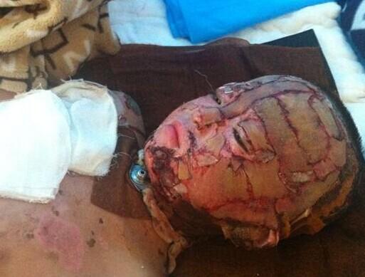 孩子脸部接受植皮