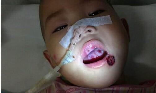 佳佳化疗口腔感染,肠梗阻,肺部感染,低钾等等症状都出现了,佳佳奄奄一息,医生几次病危通知书下达,但是坚强的佳佳用她强烈的求生意识挺过来了。