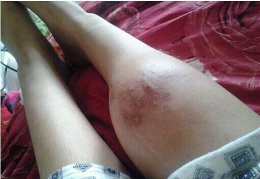 这是截至之前的照片,骨肉瘤多可怕的病