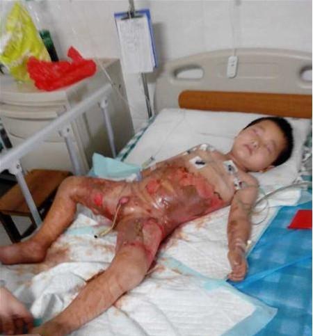 胡少忠刚烫伤时,被火速送往县人民医院,医生表示,县内医疗水平无法救治,但因暴雨,未能及时送往上级医院。