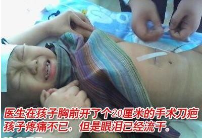 医生在孩子胸前开了个20厘米的手术刀疤,孩子疼痛不已,但是眼泪已经流干。