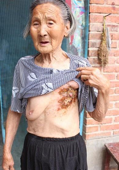 任其富老人现年87岁,患乳房溃烂,已切除一个乳房