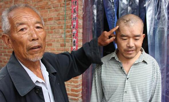 儿子因意外导致脑外伤,额头角先后做了4次手术,欠下巨额外债