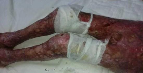 李浩是不幸的,重度烧伤,生殖器官也被烧没了。但一切又是幸运的,至少还活着,活着就有希望!