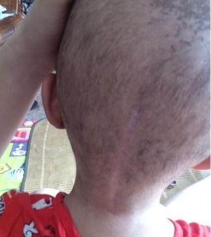 小索问开刀留下的疤痕看着都让人后怕