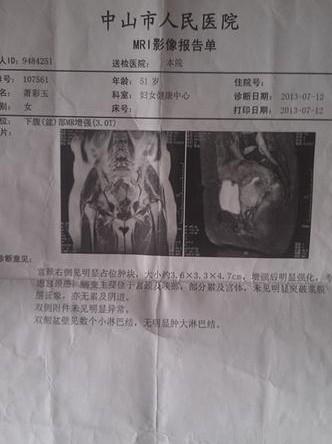 母亲萧彩玉在中山市人民医院治疗子宫颈癌的检查报告。
