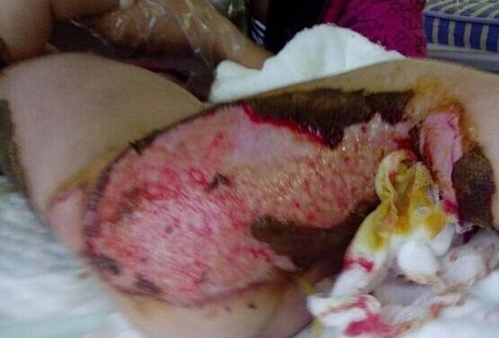 这是黄月丽烫伤的大腿