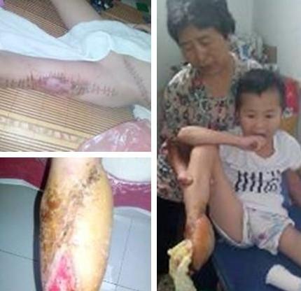 二次手术后,孩子已经截去四个脚趾,只剩小指了