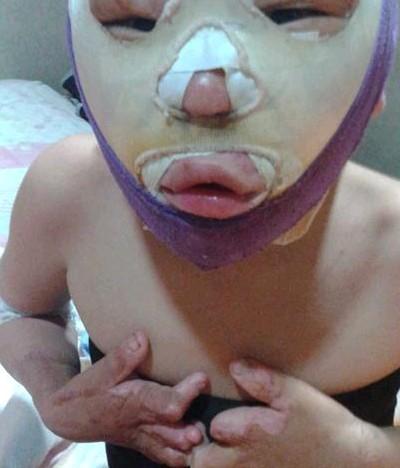 小鑫宇刚换完药戴着头套。