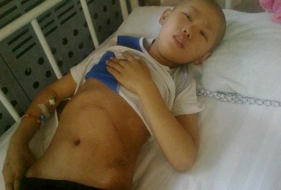 孩子生病住院了,第一次手术就在肚子上开了一个20几公分的口子。