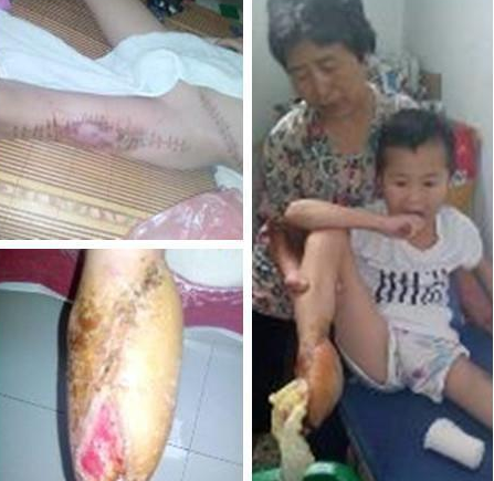 二次手术后,孩子已经截去四个脚趾,只剩小指了