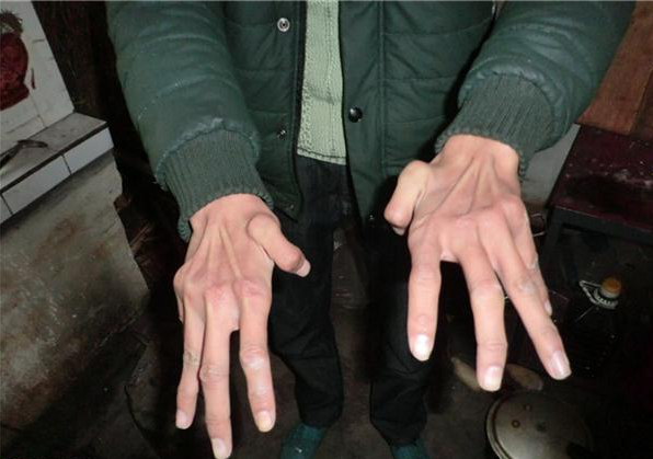 王小勇的双手有残疾。