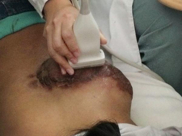 医生正在做B超检查