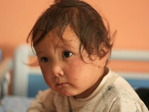 旦增德庆是第一个顺利做完手术的孩子。从病床上被抱下来的时候,她疼地一边呻吟,一边掉眼泪。因为没有钱,不舍得用镇痛棒,只能自己咬牙忍忍了。隔壁病床的德吉卓嘎看到这一幕,当下恐惧和烦躁起来。她呼吸急促,紧紧抓住妈妈的衣服,眼神里充满恐惧。才三岁的她,还不能意识到这次手术有可能改写她的一生。临近手术室时她带着深深的焦虑、不安、痛苦以及最后的勇敢。离开妈妈怀抱的那一刻,她怎么会知道,抱着她心疼她的妈妈,还在为手术费而发愁,为尽可能省去更多的治疗费让她承受没有镇痛剂的痛苦而自责呢?