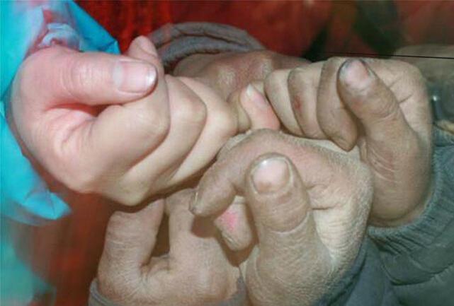 在韦州像阿依舍(经名)一样的孩子很多,他们要么父母离异,要么单亲或者是孤儿,从而导致他们跟着爷爷奶奶生活,在心理上已经受到重大创伤的同时,其生活各方面也面临很大困难,而疾病频发导致的高额医疗费用是笼罩在他们头上的浓重阴霾。